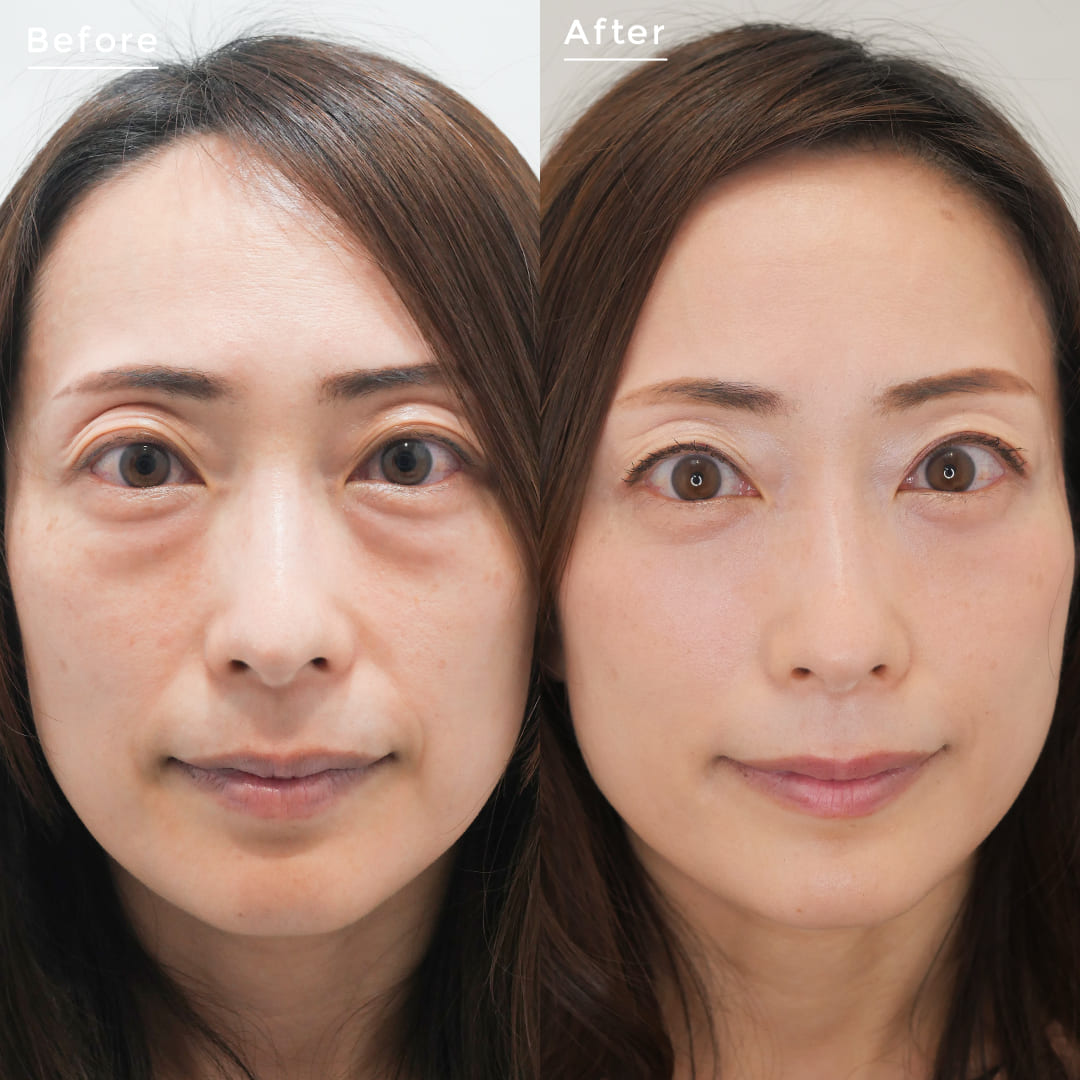 下眼瞼脱脂術