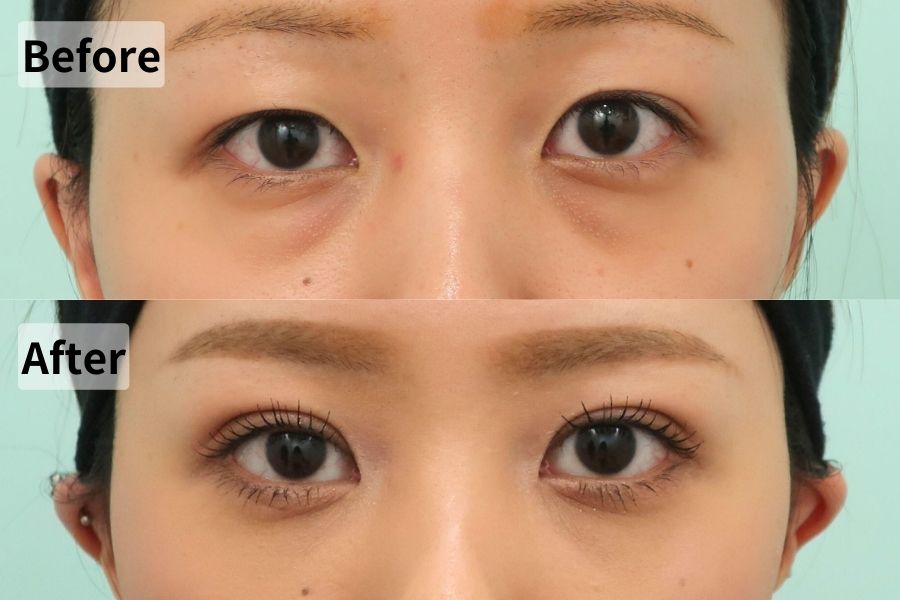裏ハムラ、埋没6点 留め